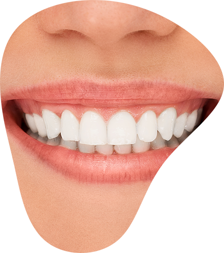 BLANQUEAMIENTO DENTAL