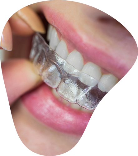 INVISALIGN